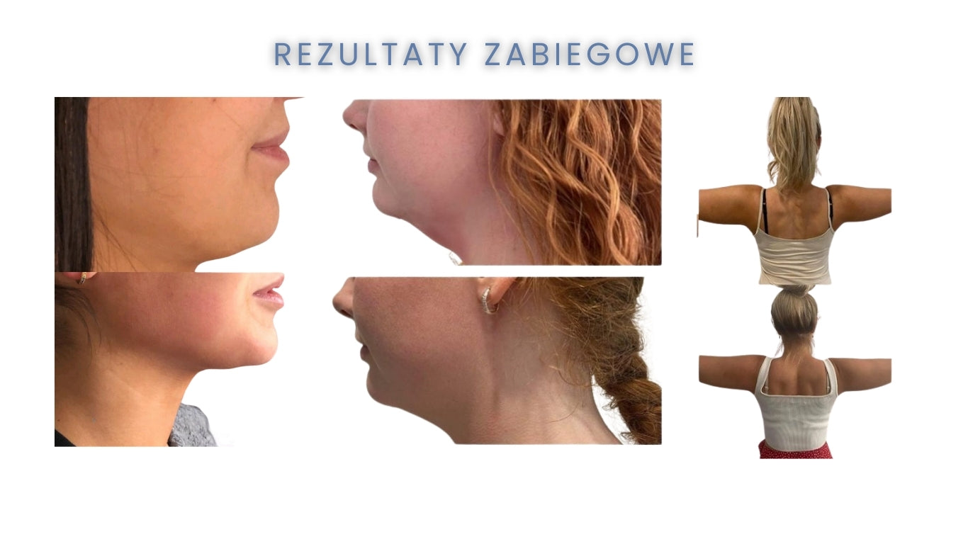 Urządzenie Kosmetyczne - Lipo Freeze 4D Next Generation Kriolipoliza