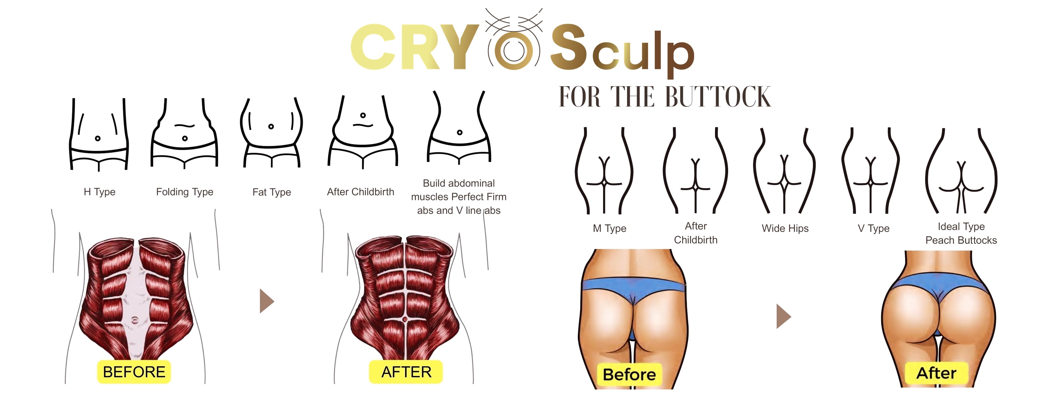 Urządzenie Kosmetyczne - CryoSculp Kriolipoliza + Fala Elektromagnetyczna