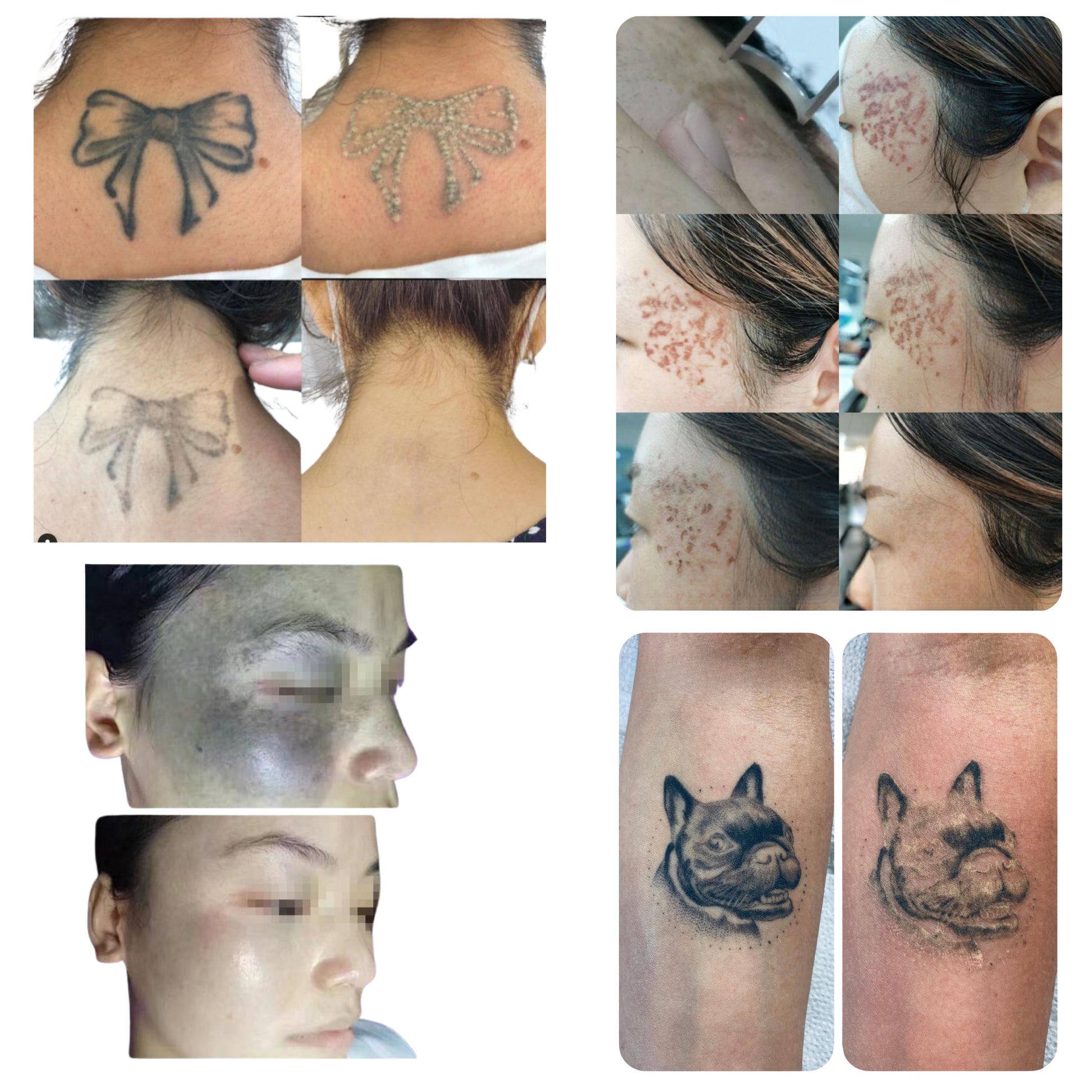 Urządzenie Medyczne -DVPico Medical Laser - Laser Pikosekundowy