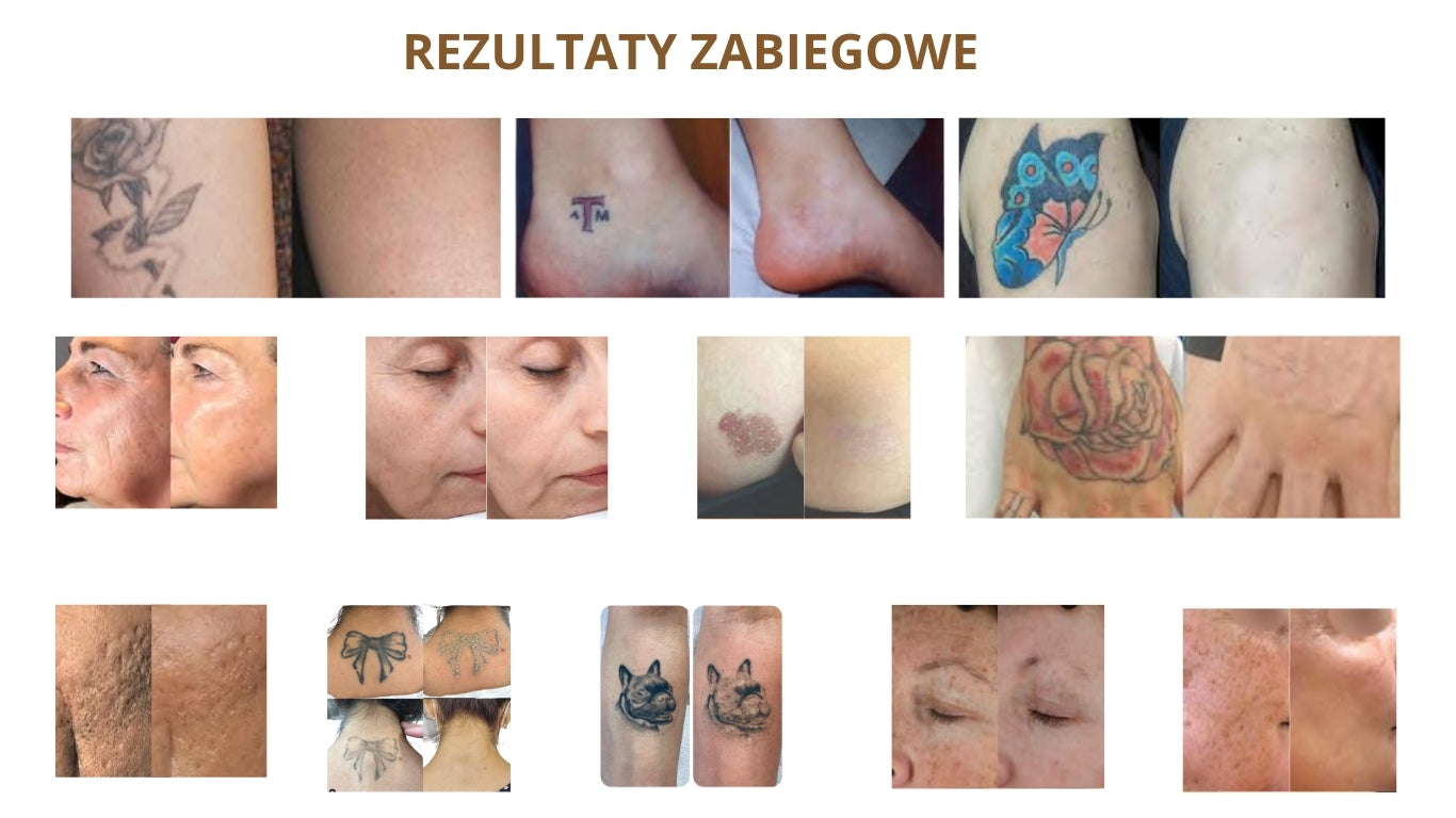 DVPico Medical Laser New Generation - Laser Pikosekundowy