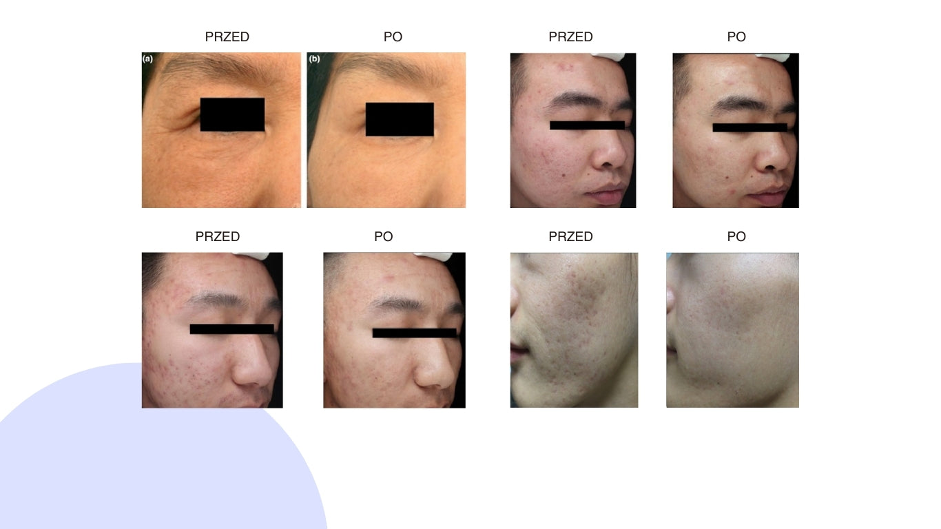 Image Group Revitelis - Laser 1565nm