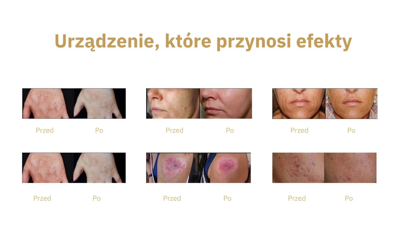Urządzenie Medyczne - Magic RF Frakcyjne Fale Radiowe