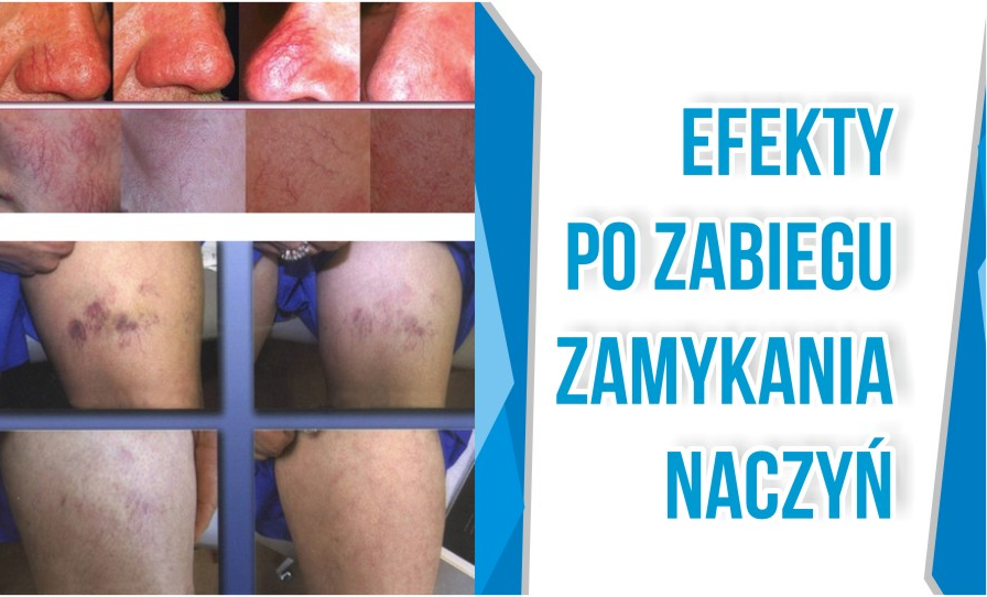 Urządzenie Kosmetyczne - K-MED Technologies III - Elektrokoagulacja
