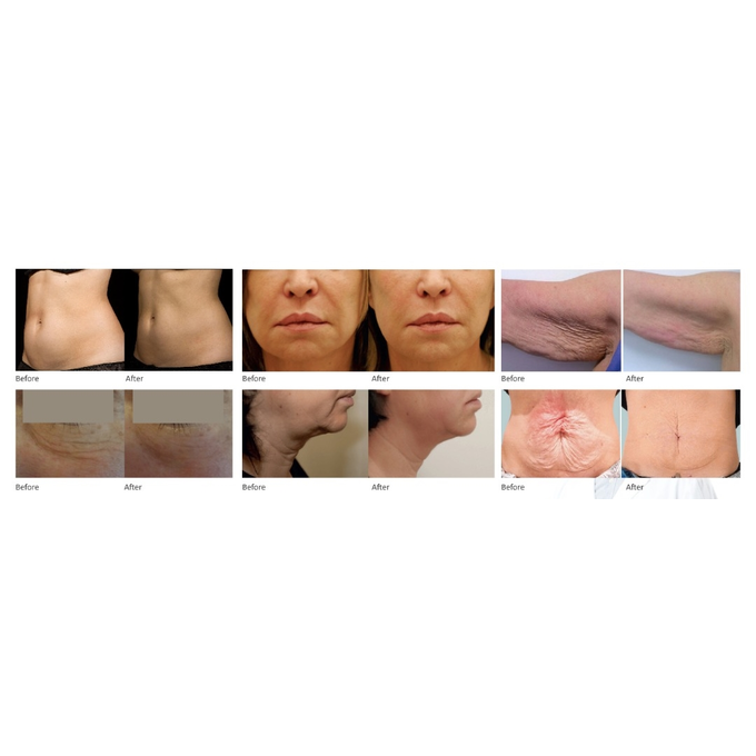 Urządzenie Medyczne - HIFU 5D Exclusive 4 Głowice - Sklep i